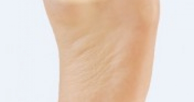 How to heal a blister ?